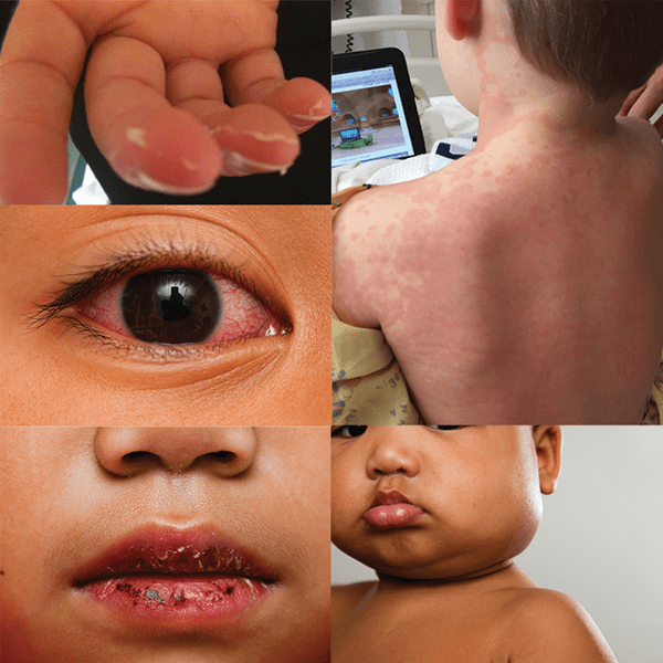 collage of symptoms of Kawasaki disease